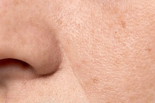 Piel con poros dilatados (Freepik)